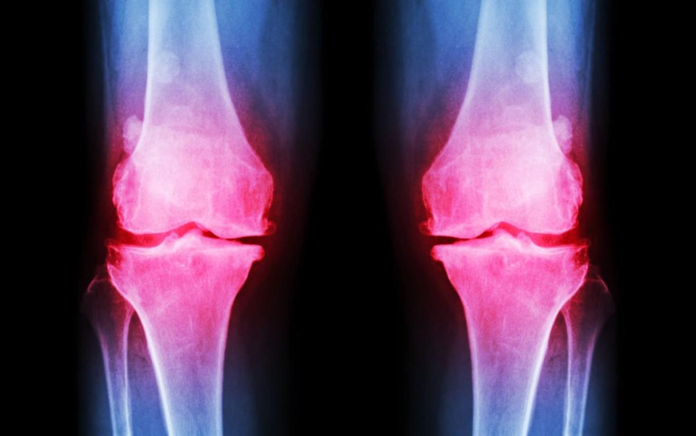 Medical bone scan of human legs showing osteoarthritis in the knees