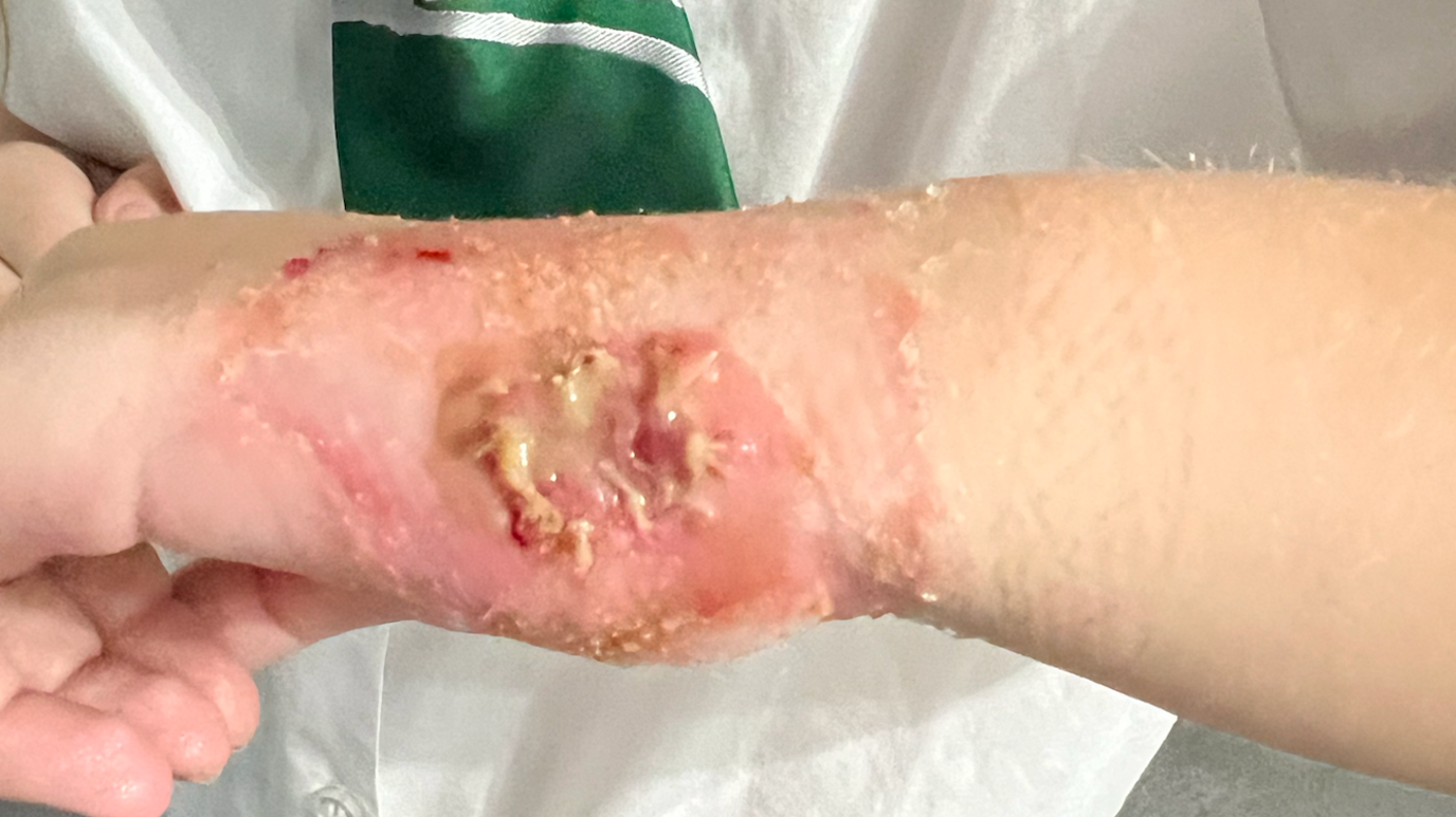 Chloe showing her arm where the glue burnt her wrist with graphic injury.