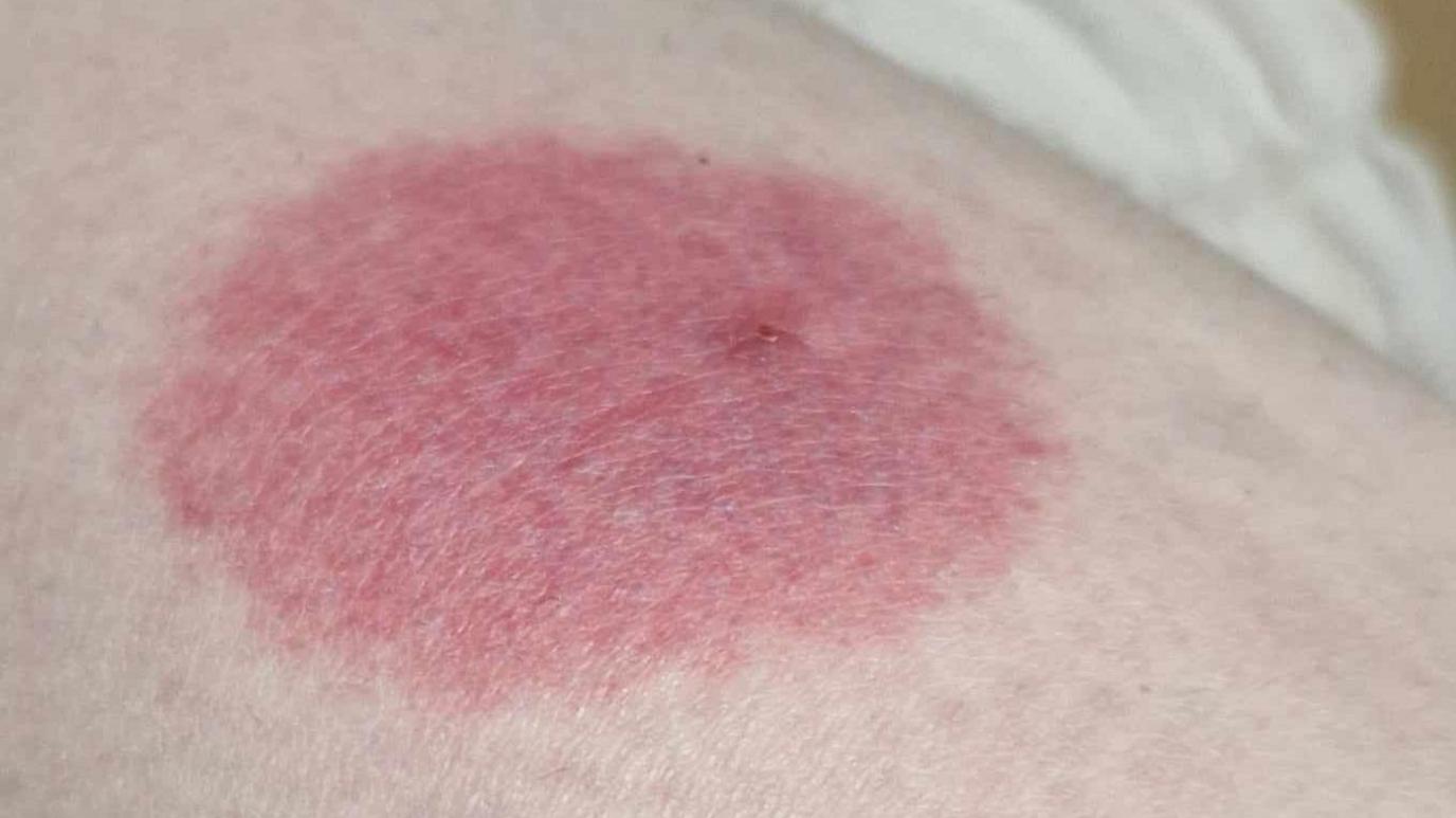 A red rash on the arm of a woman from Ballykelly, where there has been a rise in the number of people reporting to have been bitten by insects