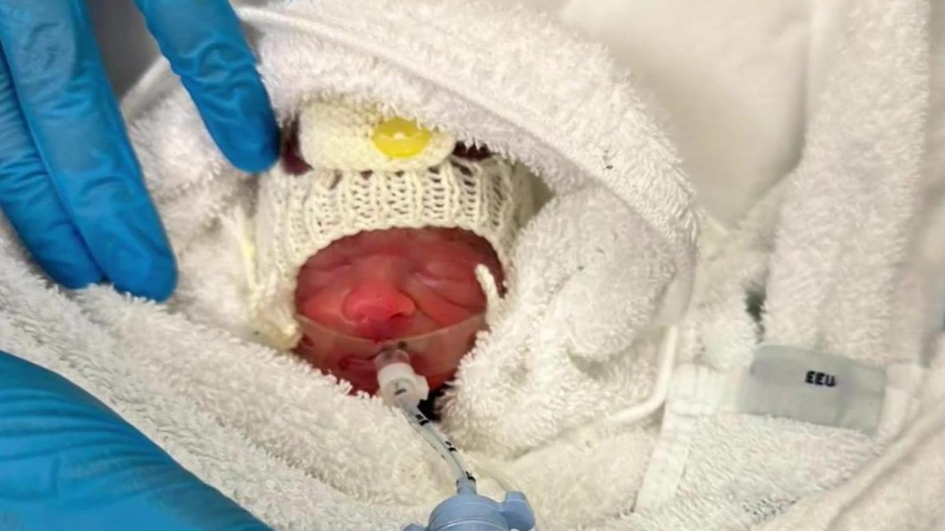 A very small premature baby wrapped in towels with a tube in its nose. It has a very red face and is wearing a knitted hat.