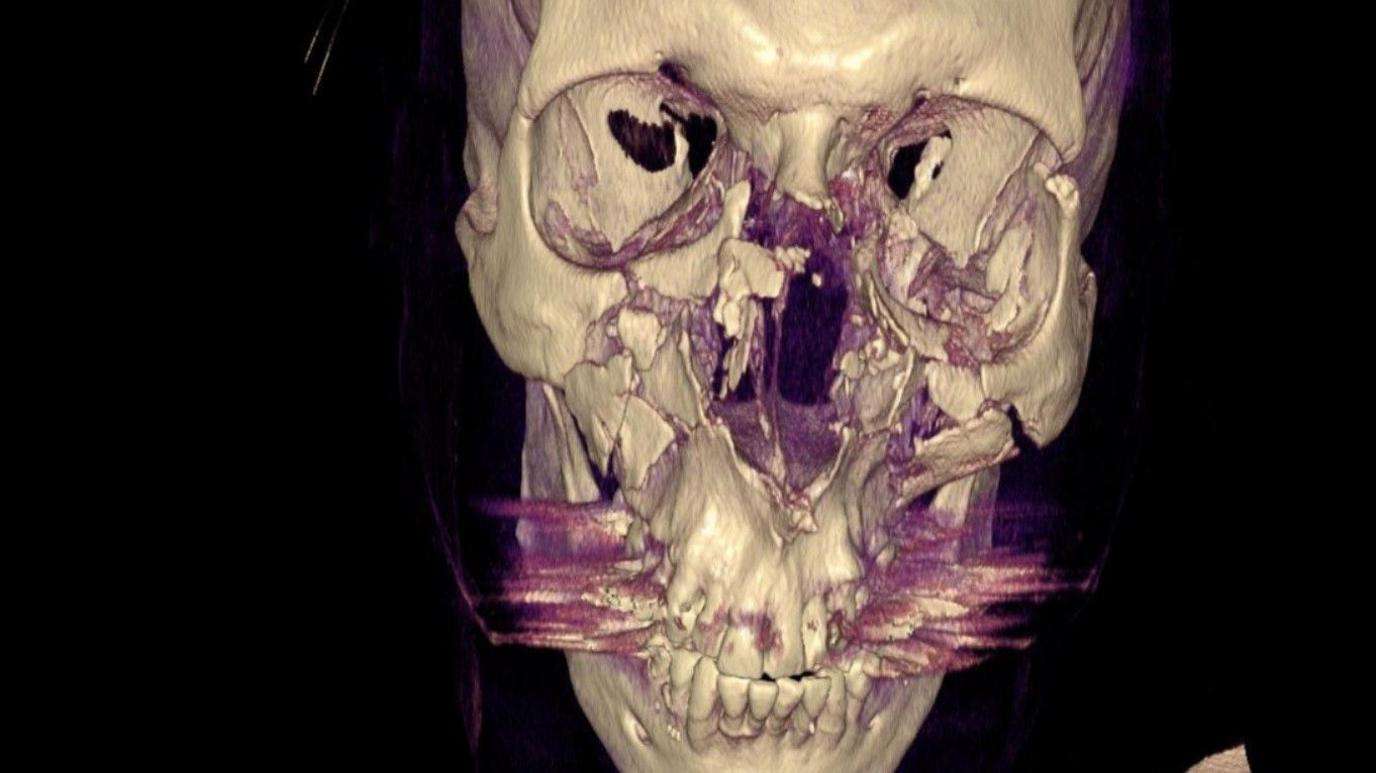 An X-ray of Bishop Chessun's skull showing the extent of his injuries with many broken bones and damage to his eye sockets. There are purple streaks across the skull