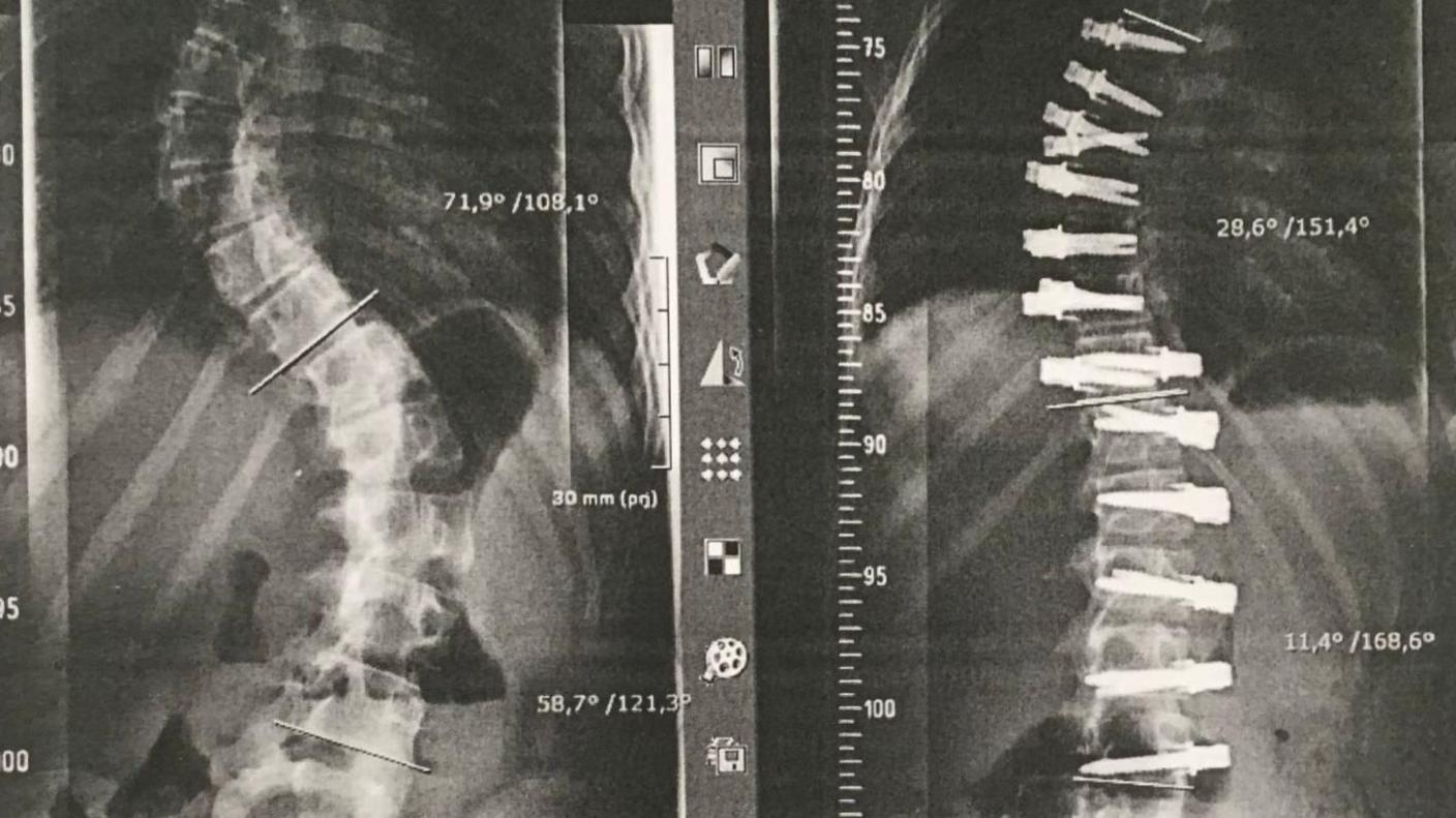 An X-ray showing two pictures of a spin, one that is really bent and the other straighter, with a number of pins in it.