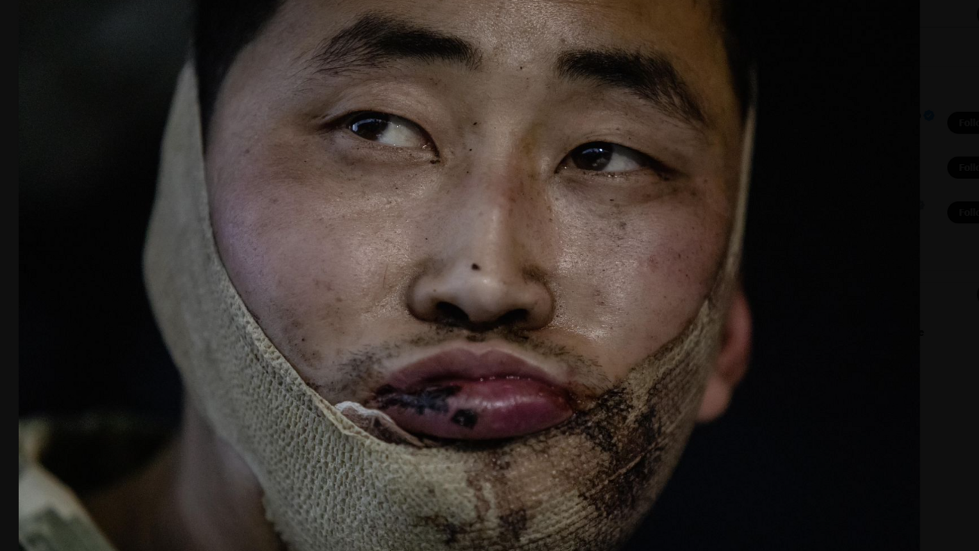 A man who is a reported North Korean prisoner of war with an injured lip and a bandage around his jaw looks off camera