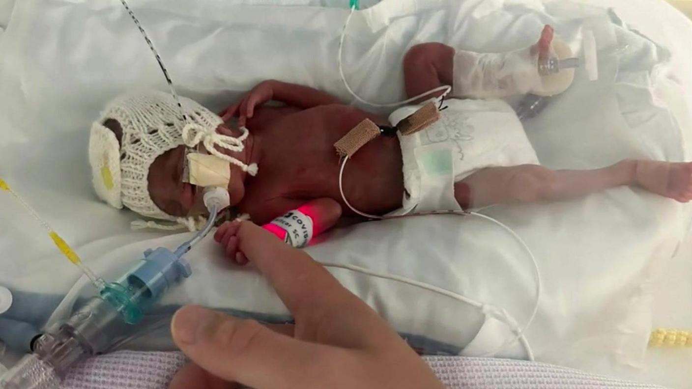 A tiny premature baby in a hospital cot with a tube in its nose.