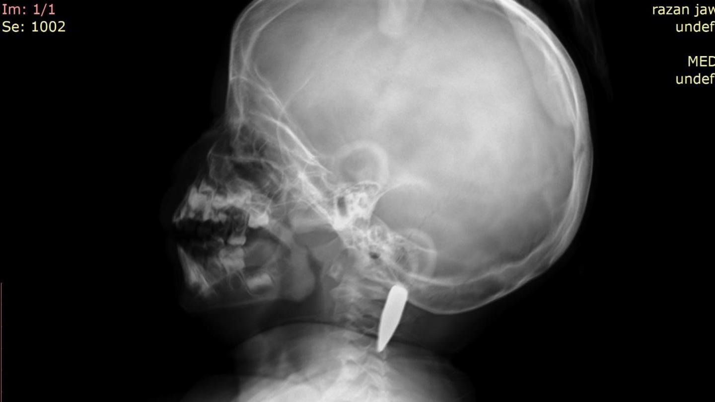 A CT scan showing a bullet in the back of the girl's neck