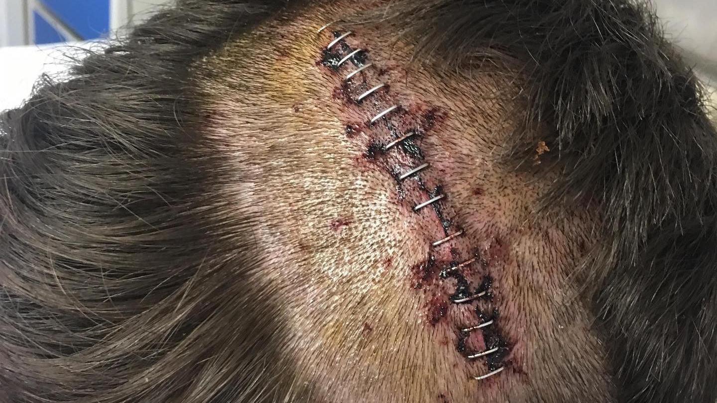 The top of a scalp with dark hair and an operation scar with stitches.