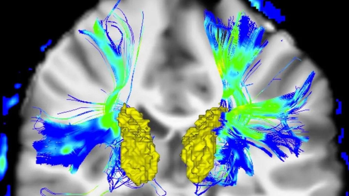 An image of a brain scan showing how the treatment affects the nerves.