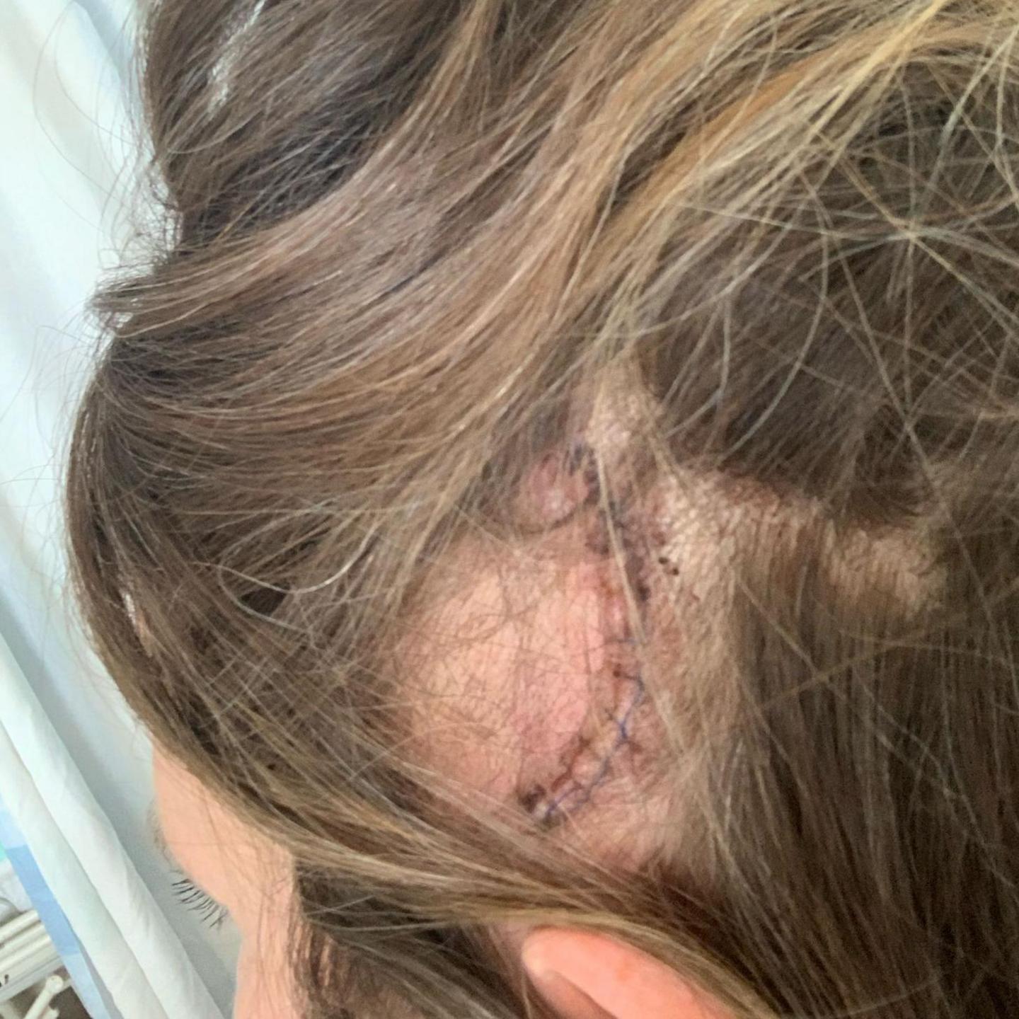 A close up of a large patch of hair missing on Lucy's head, and a curved surgical scar.