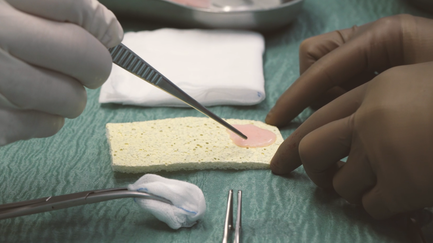 A close-up image of a pink-coloured lab-grown patch of heart muscle sitting on a yellow sponge, which is being picked up by a surgeon wearing gloves and holding tweezers