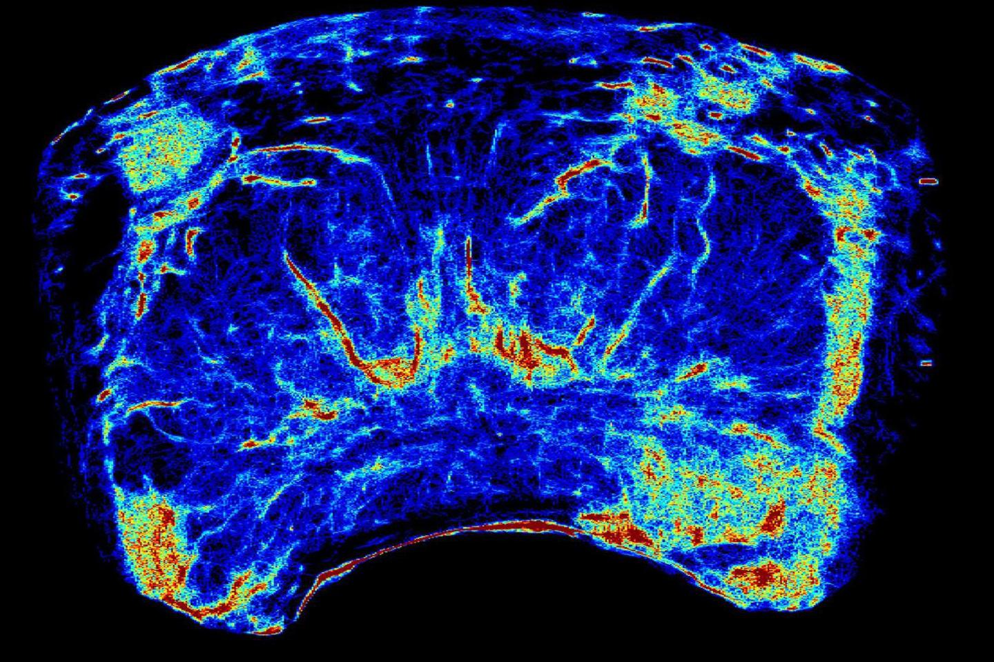 Prostate scan image shows the highlighted areas within the organ - the problem areas show up as a deep orange/red colour, where the rest of the prostate is in yellow, green and blue.