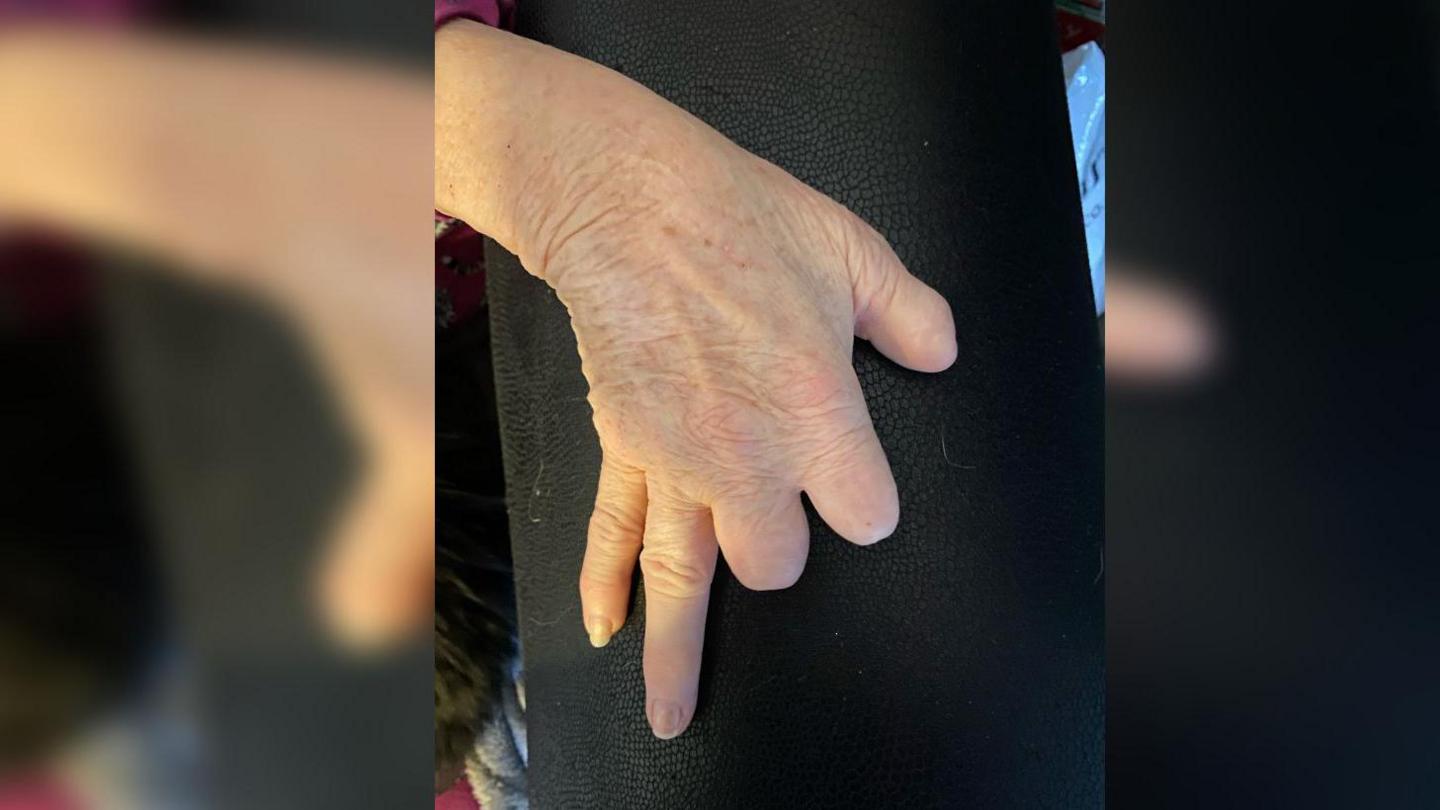 A hand that is missing two fingers and a thumb.