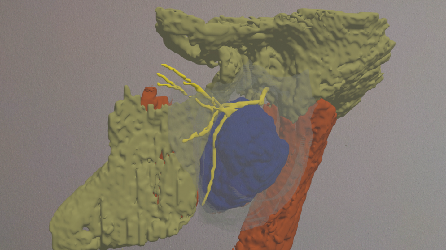 The hologram shows a large blue section that is the tumour with the yellow facial nerve running through it. The neck is red and the rest of the head is green.