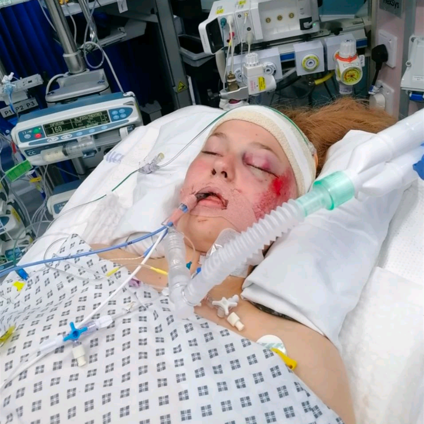 A girl lies in a hospital bed. She has several tubes attached to her and going into her mouth. She has a bandage around her head and a large graze on her face.