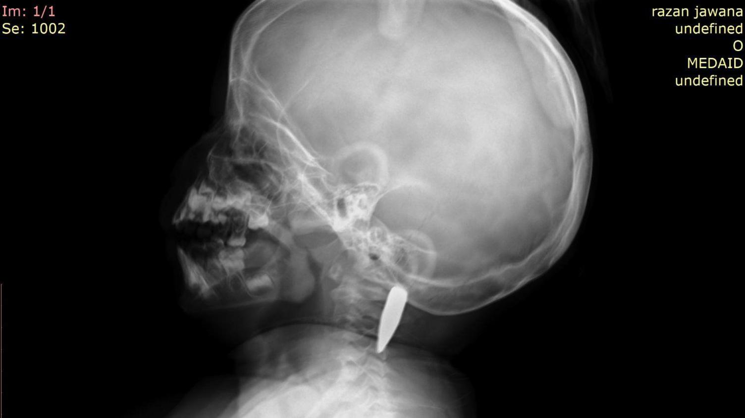 A CT scan image which shows a small child's skeleton (Razan's) with a bullet lodged in the neck