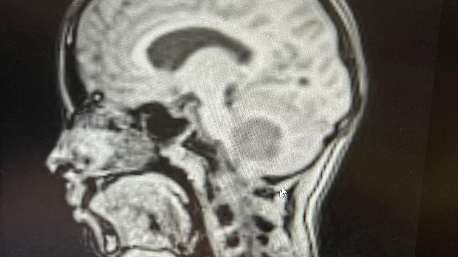 An MRI scan showing the apricot-sized tumour at the base of Amelie's skull and the top of her spine. It is a dark grey patch against the light grey showing the rest of her brain. 