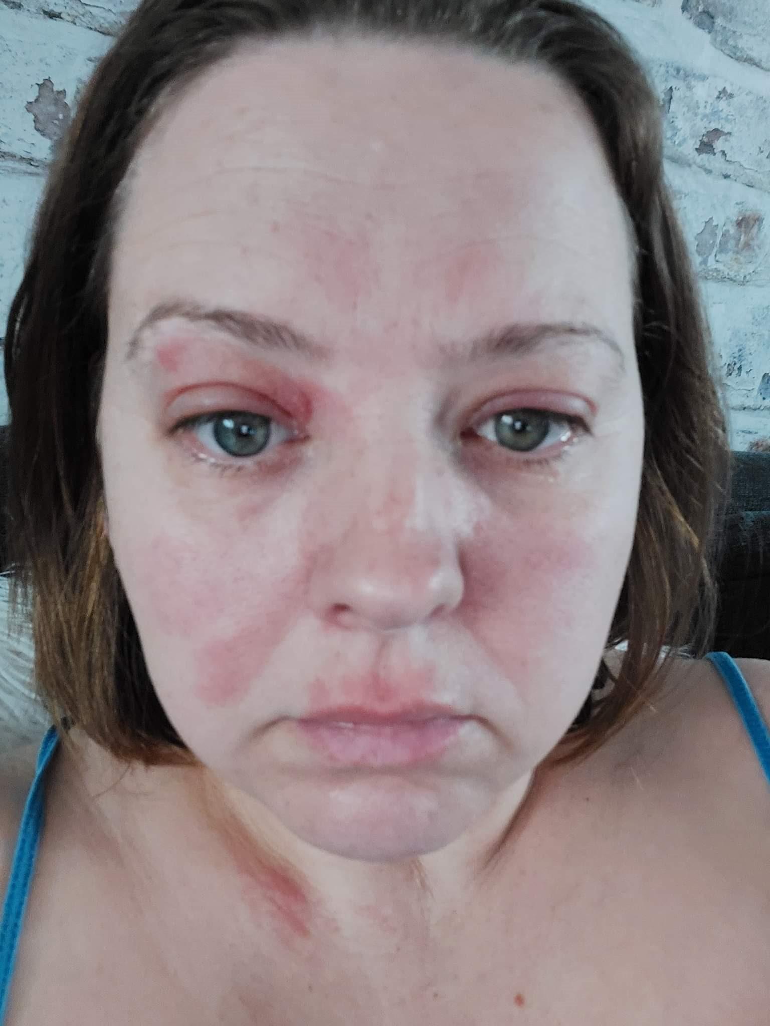 Close-up portrait of a woman with swollen eyelids, lips and a rash on her face