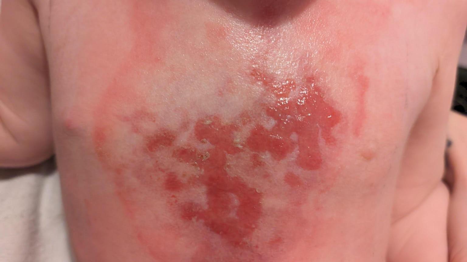 Close-up of burns on a young girl's chest after a hot cup of tea fell on her.