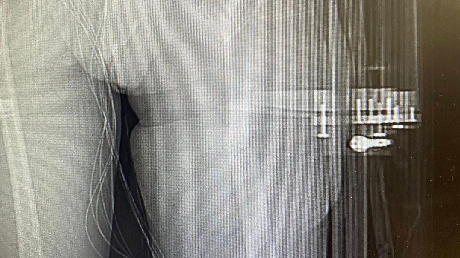 An X-Ray of Harry Pyett's broken femur.