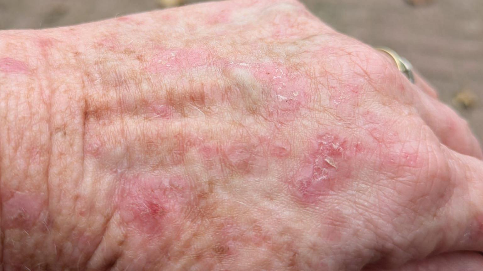 A view of Mrs Smart's hand which is covered in red sores and peeling skin.