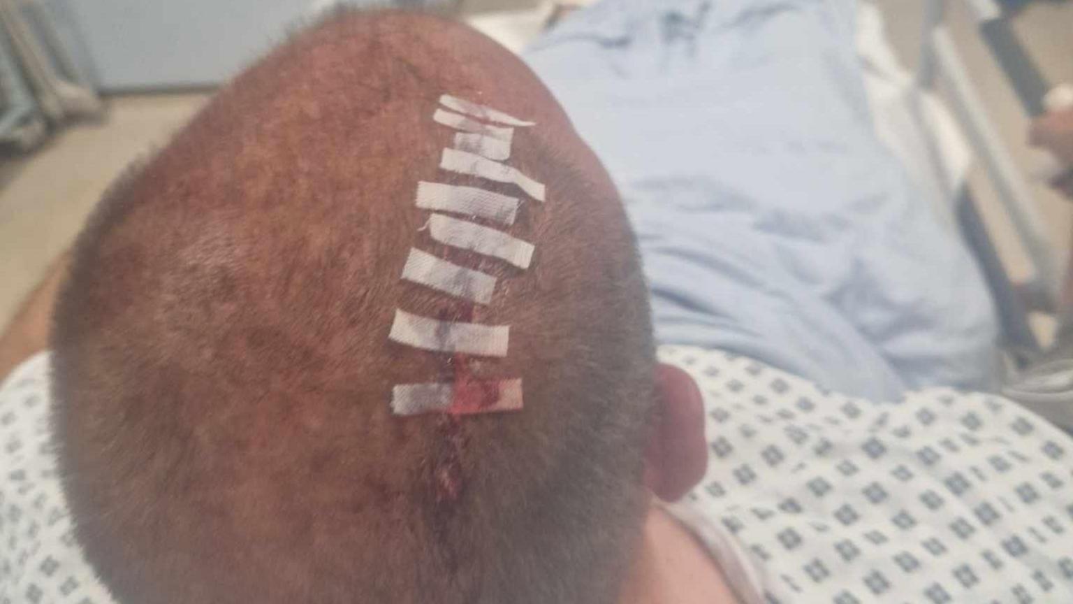 Mr Mallet's head injured pictured while he was in hospital