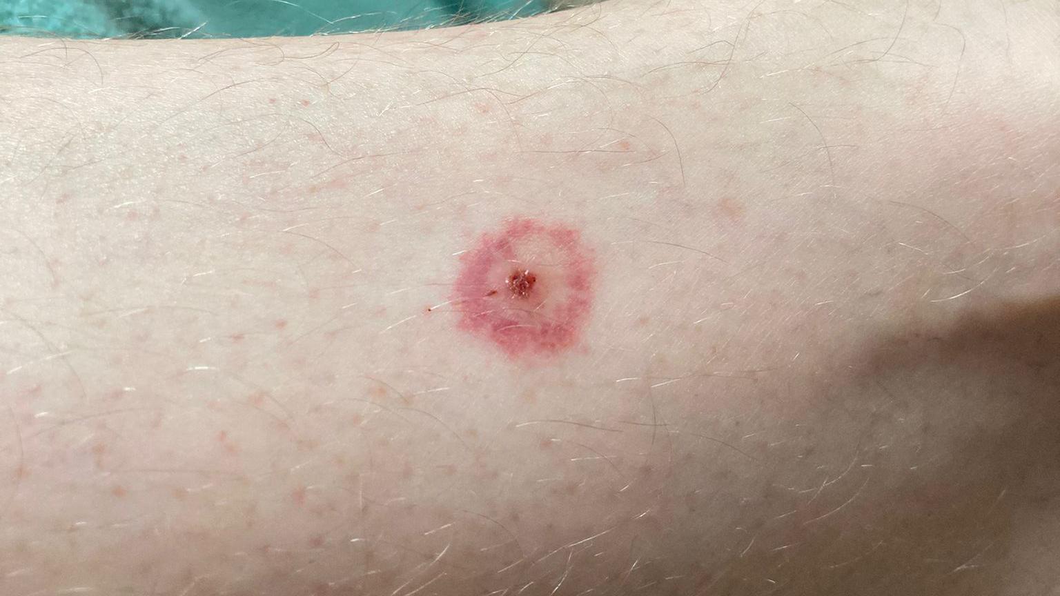 A red circular rash with a red middle on Luke Pickett's skin.