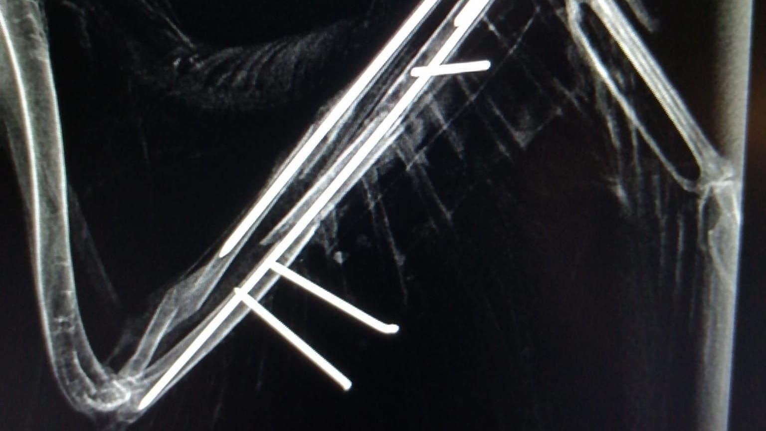 An X-ray showing pins in the bones holding them together.