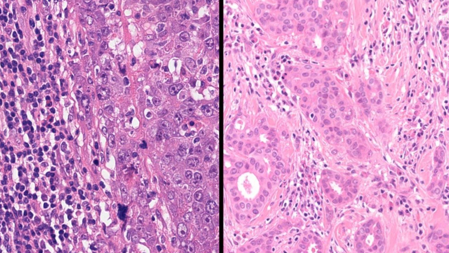 Two anonymised slides of breast cancer tumours to show the difference in breast cancer types under the microscope. Left is the BRCA 1 breast cancer type which is a higher grade cancer with more inflammatory cells, while this non BRCA cancer is lower grade with few inflammatory cells. They need to be treated in different ways.