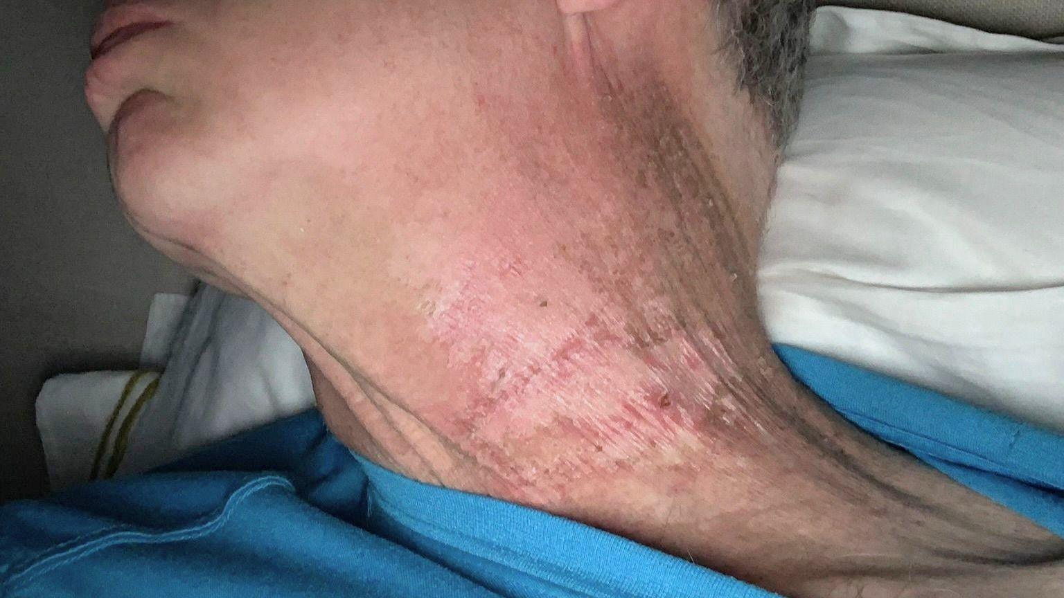 A close up picture of Mr Emerson's neck following radiation treatment. He is lying in bed wearing a blue t-shirt. The skin around his neck looks dry, sore and red.