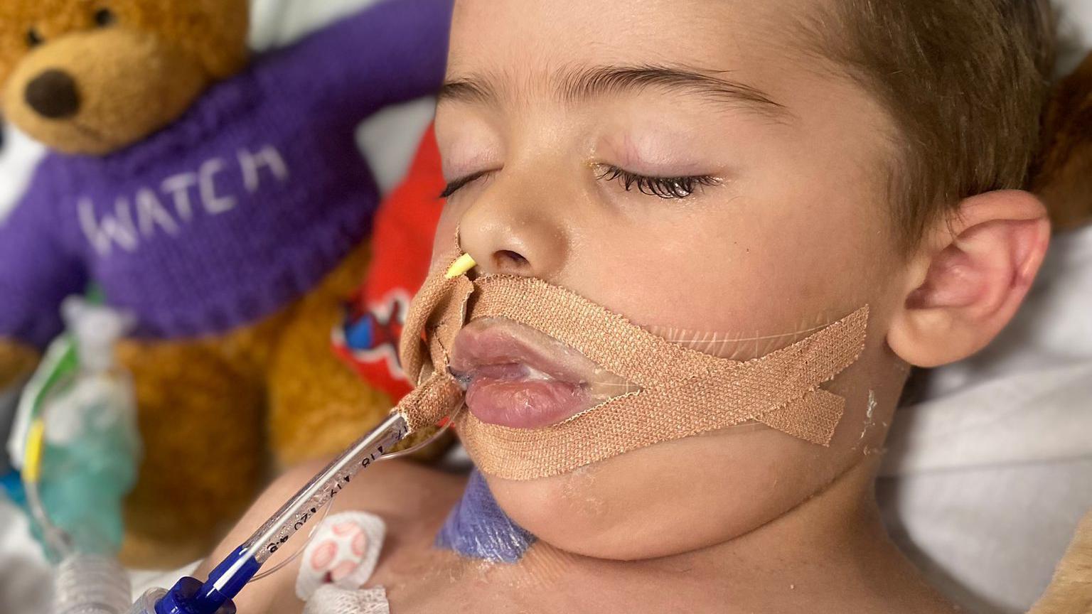 Three-year-old Freddie lying in a hospital bed with a tube going into his mouth attached with skin coloured tape. His eyes are closed and a teddy is visible in the background