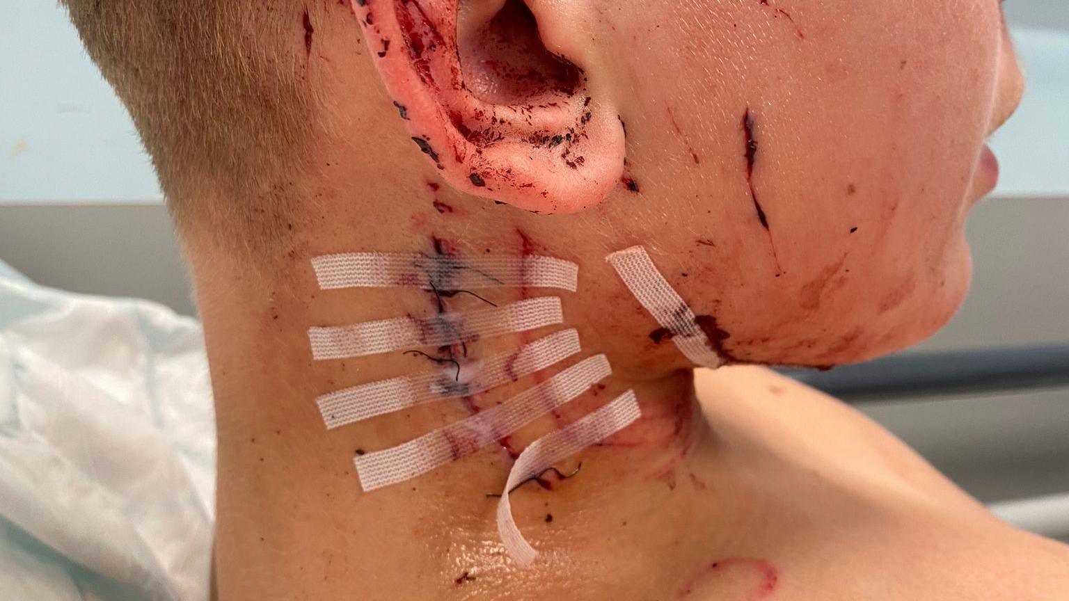 Close up shot of side of boy's blood-covered ear and neck - with a dressing strips applied over stitches