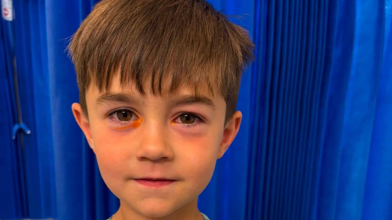 Hudson, a young boy seen with major irritation around his eyes. His left eye has a swollen and bruised colour to it underneath the retina. His right eye has an orange tint underneath.