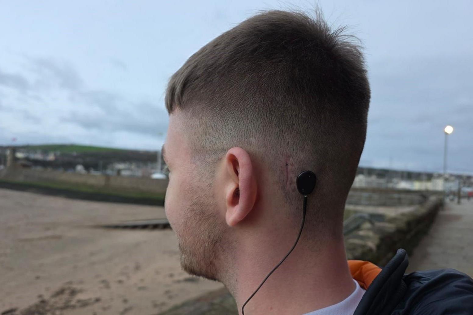 Adam Atkinson standing on a beach with the sand in the background. He is facing away from the camera so you can see a black wire attached to the back of his head. There is a small scar next to the device attached to the lower part of his head.