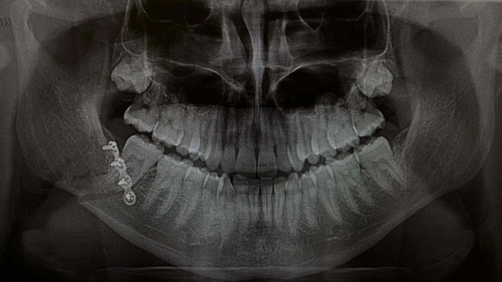 An x-ray image of metal plates in a broken jaw