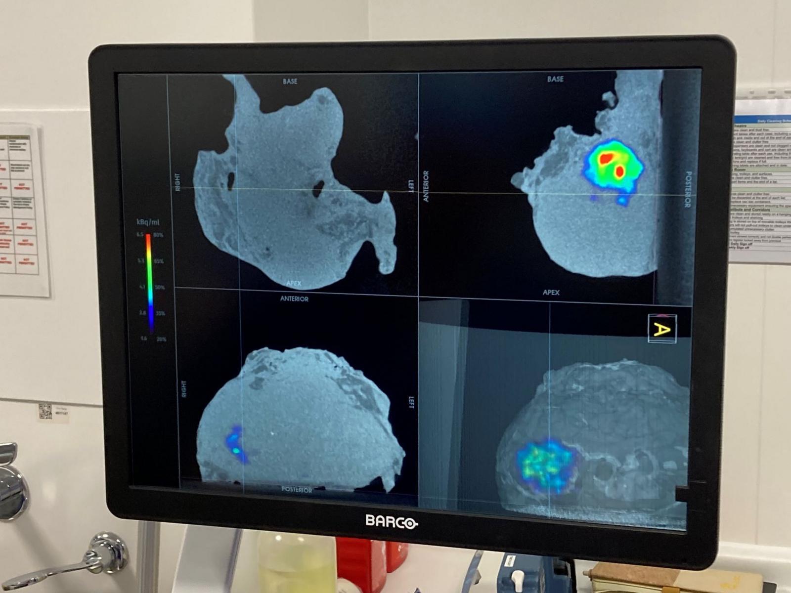 A computer screen shows images from a medical scan, with a small blue, yellow, green and red patch on a larger grey area.