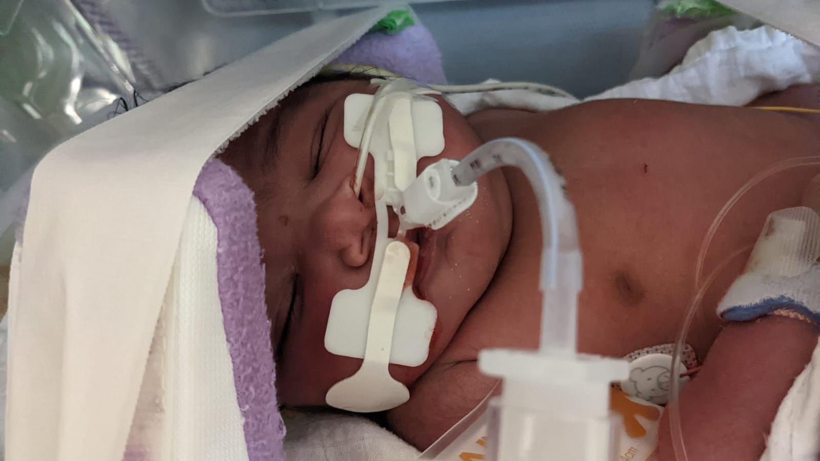 A picture of Sara as a newborn baby with tubes going into her nose and mouth.