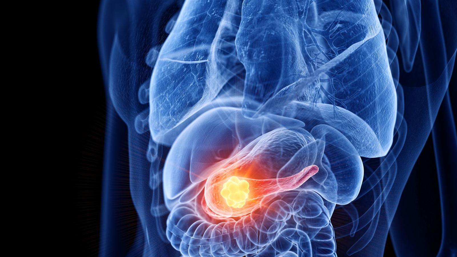 Image of pancreatic cancer