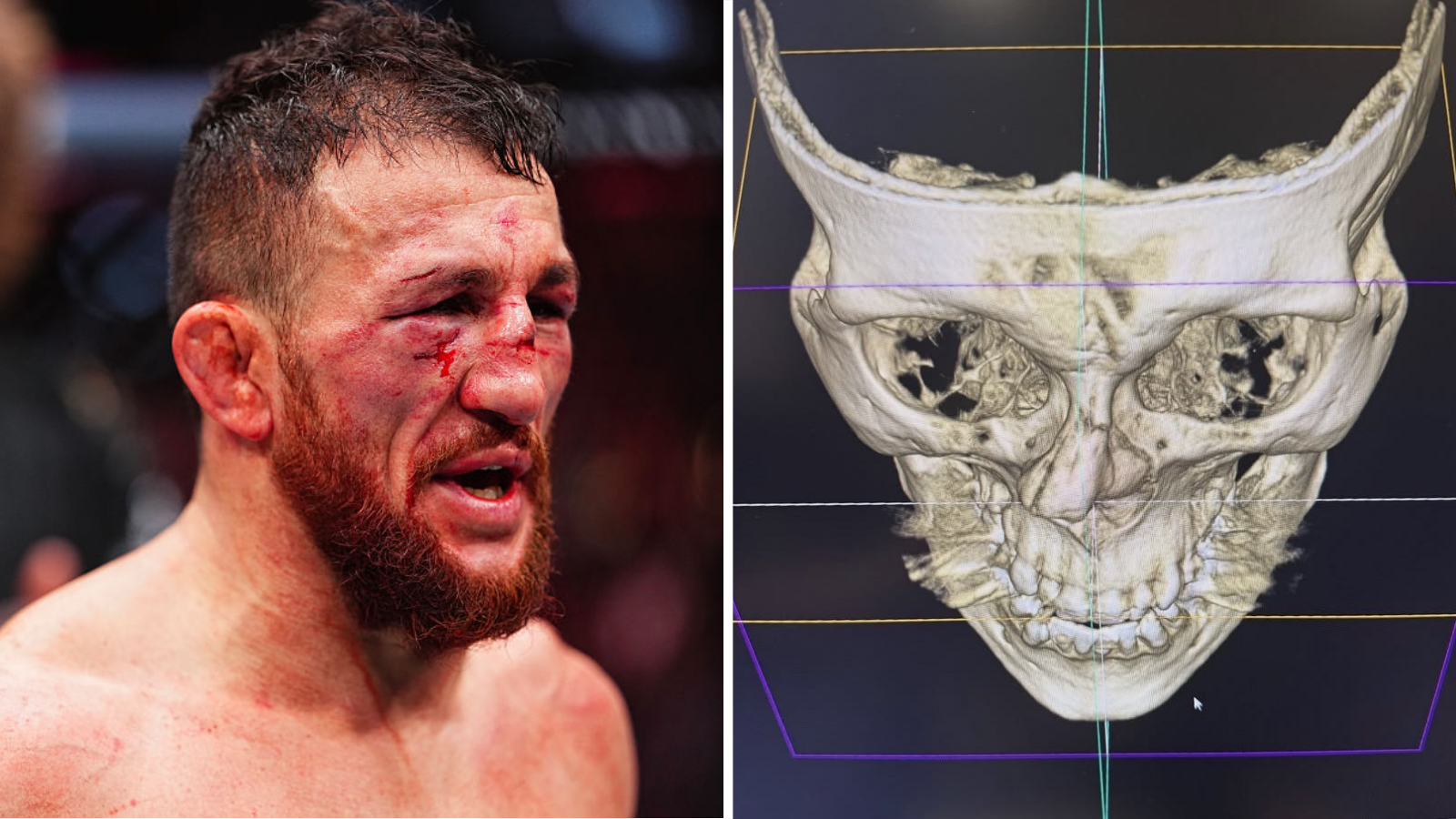 Split image of Merab Dvalishvili's nose bleeding and crooked in a fight and a scan that shows a nose broken in two places 