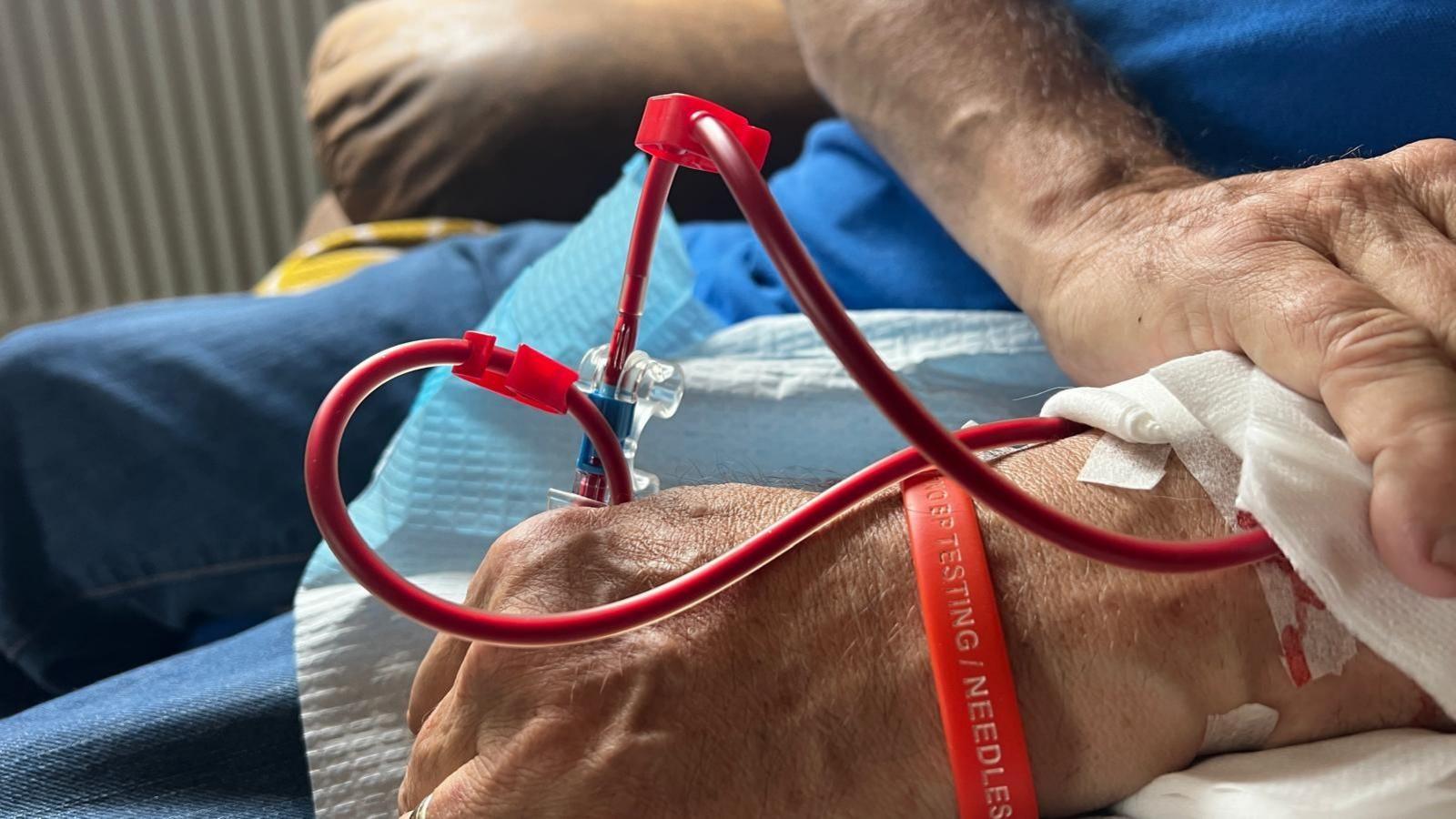 Mr Henderson's left hand close up. You can see blood passing through tubes into his arm while he is undergoing dialysis. He has a red dialysis awareness wristband on his hand. He is putting pressure on his left hand on his right hand because it is bleeding, you can't see the blood from this.