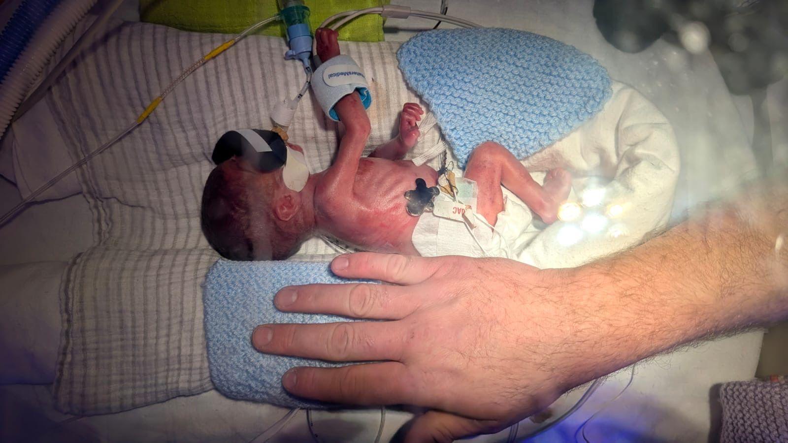 A baby in hospital with tubes and wires attached to its mouth and body. A man's hand is next to him, showing how small he was when was born.