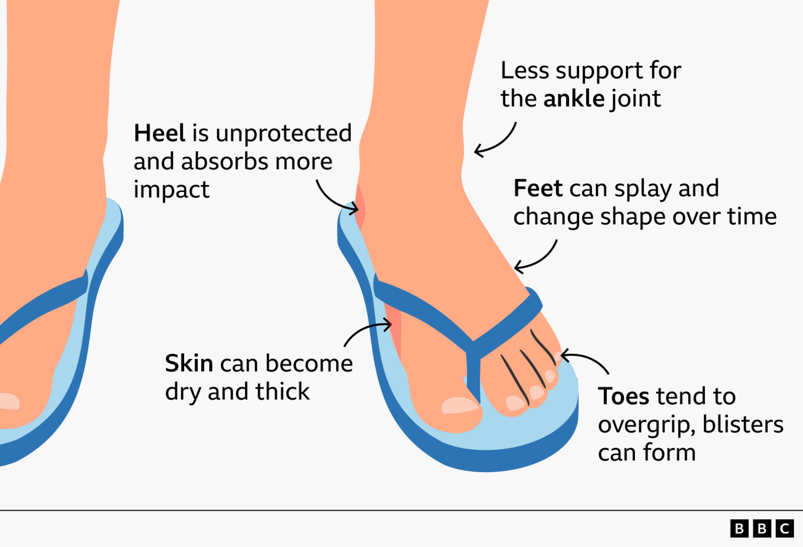 Illustration of two feet in flip flops with arrows pointing to skin, toes, ankle and heel 