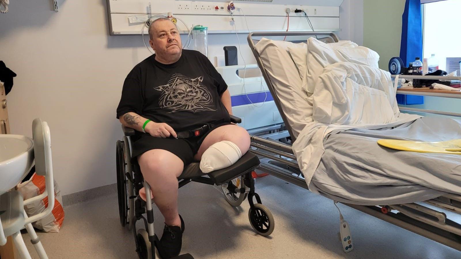 A man is sitting in a hospital room in a wheelchair. His left leg has been amputated below the knee and has a bandage over the end.