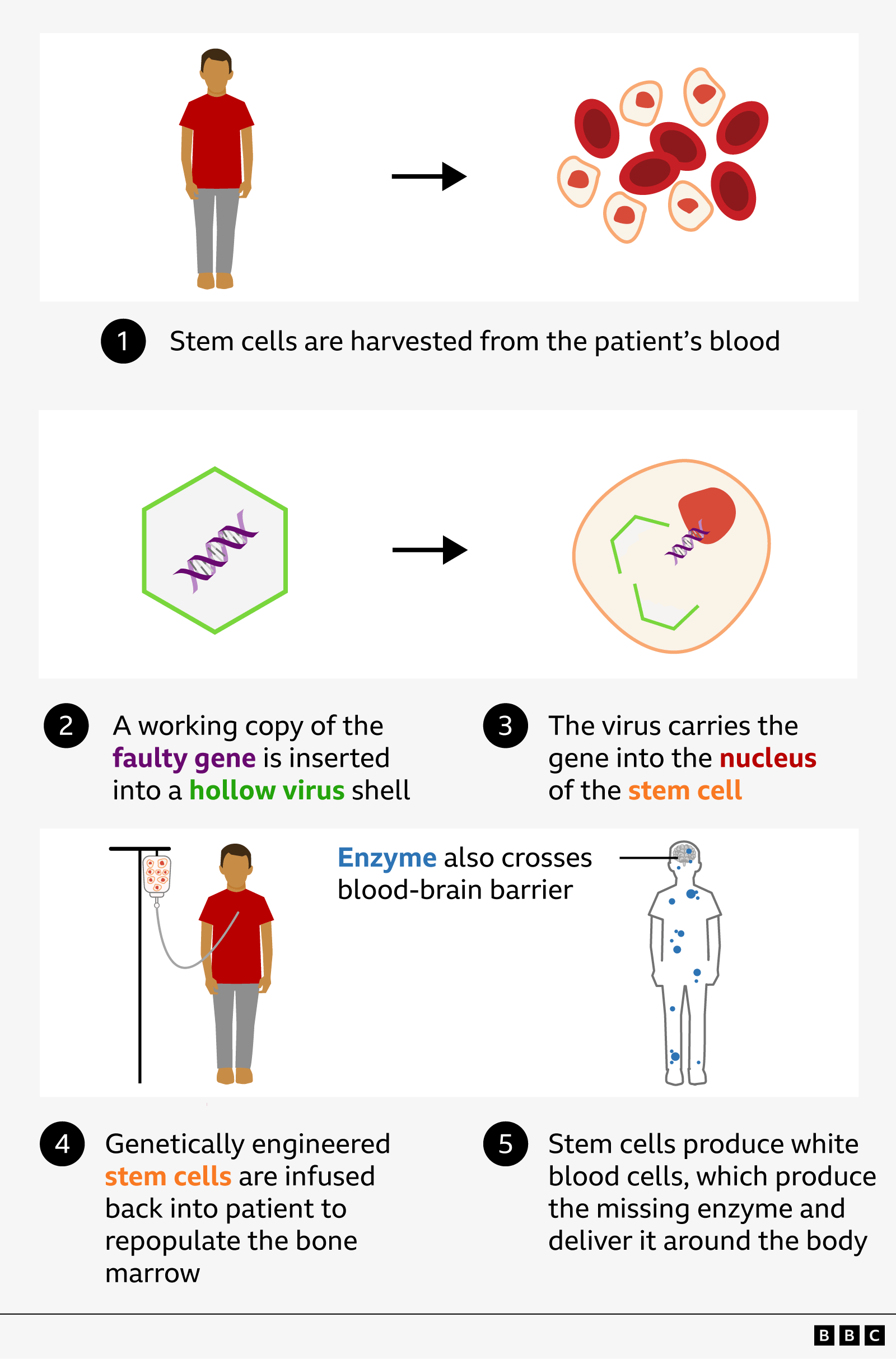 Graphic showing how genes are tweaked to treat Hunter syndrome
1. Stem cells are harvested from the patient's blood
2. A working copy of the faulty gene is inserted into a hollow virus shell
3. The virus carries the gene into the nucleus of the stem cell
4. Genetically engineered stem cells are infused back into patient to repopulate  the bone marrow
5. Stem cells produce white blood cells, which produce the missing enzyme and deliver it around the body