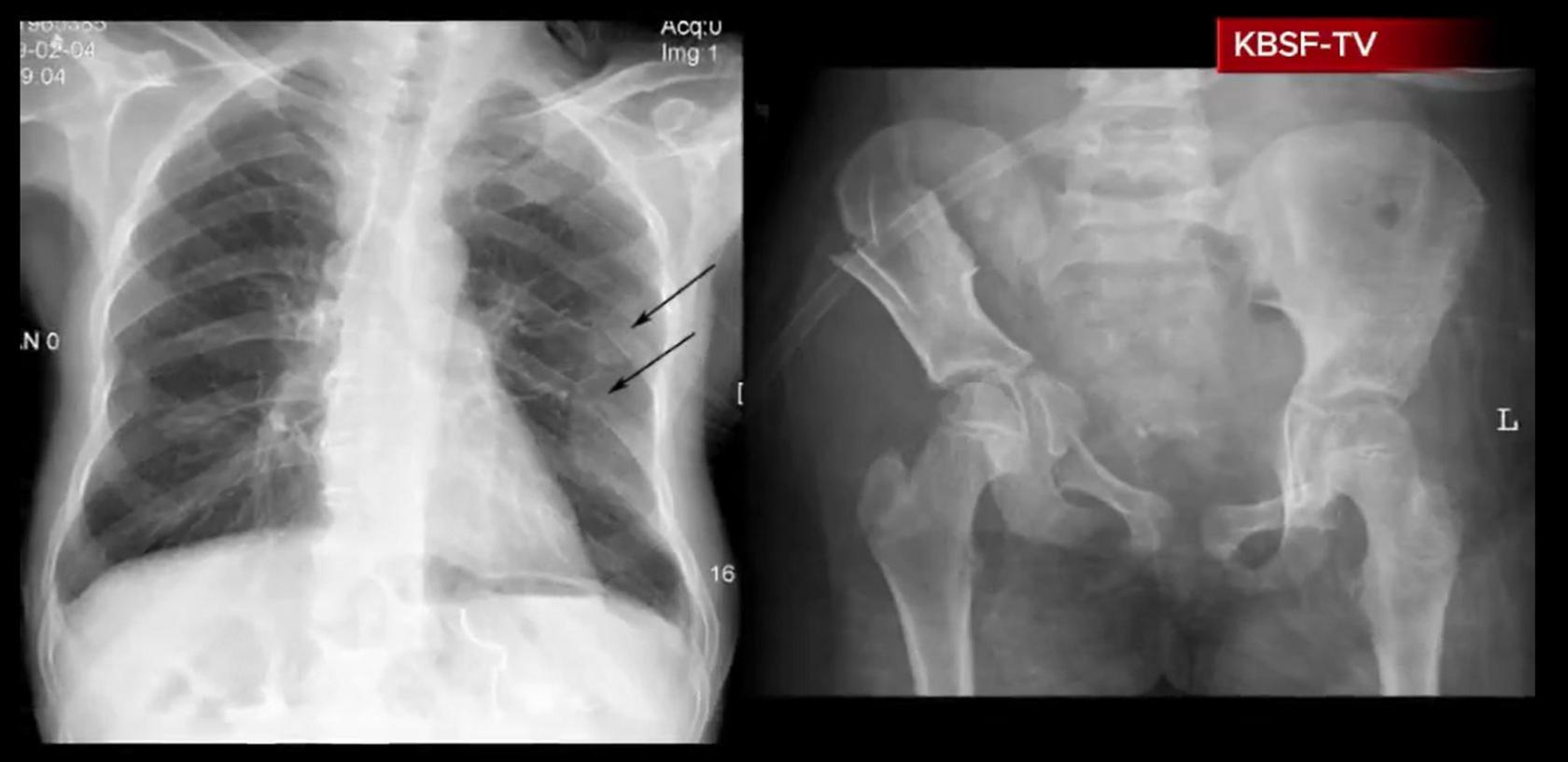 Screenshot of X-rays shown in the hit-and-run video