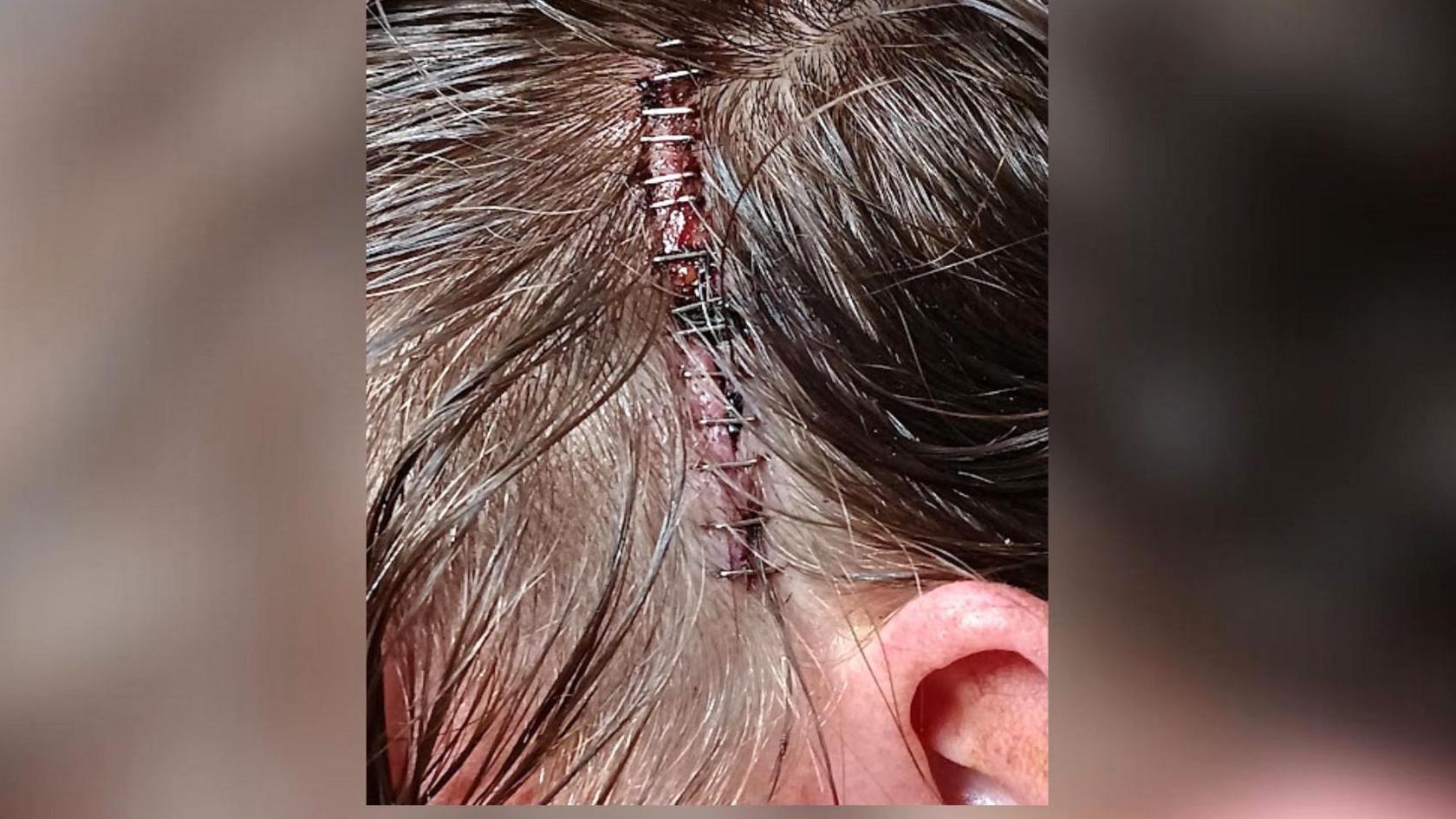 Close up of a woman's head showing a scar inbetween her dark hair with several stitches. 
