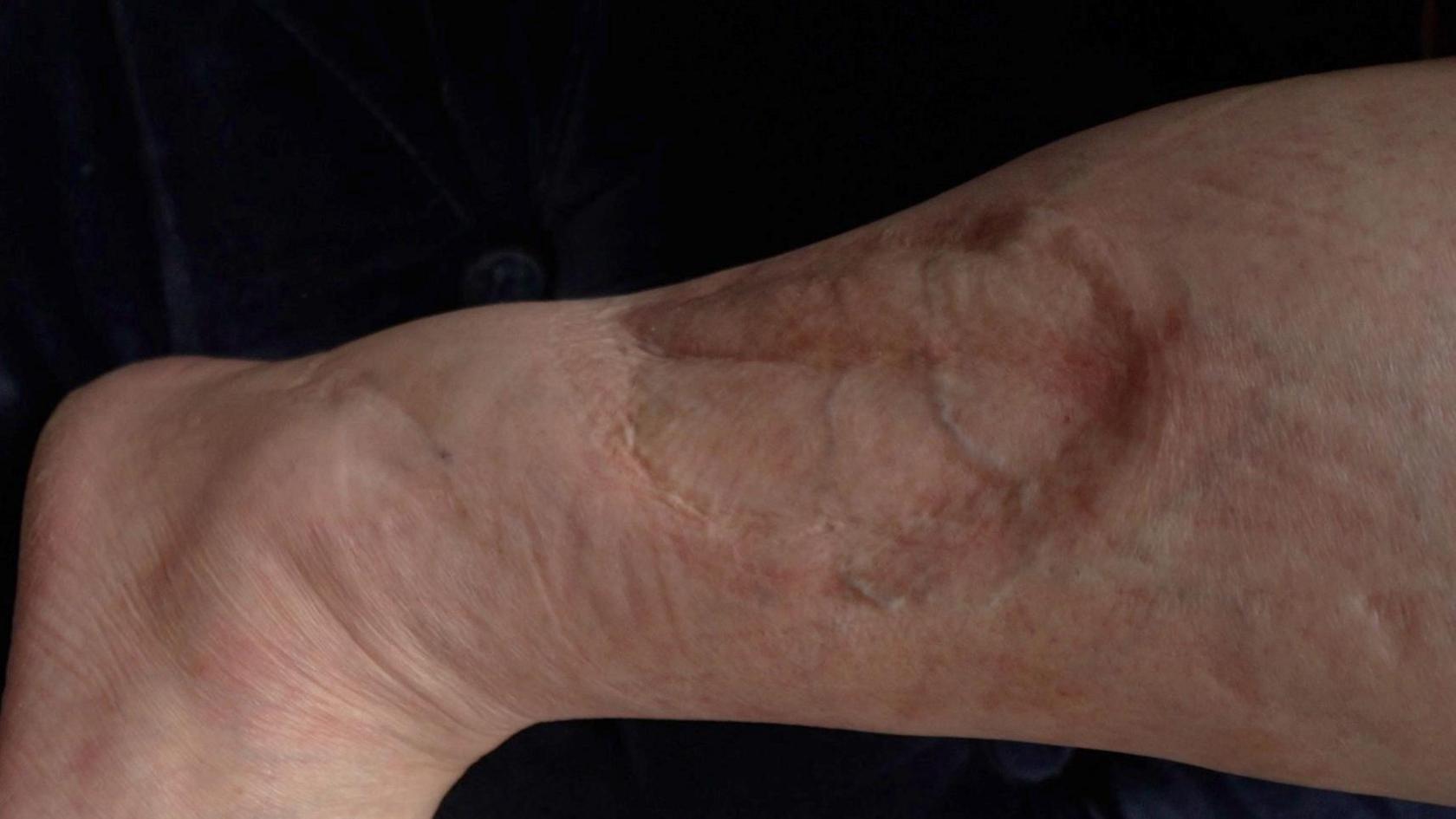 A picture of a scar on Mrs Greenwood's right leg.