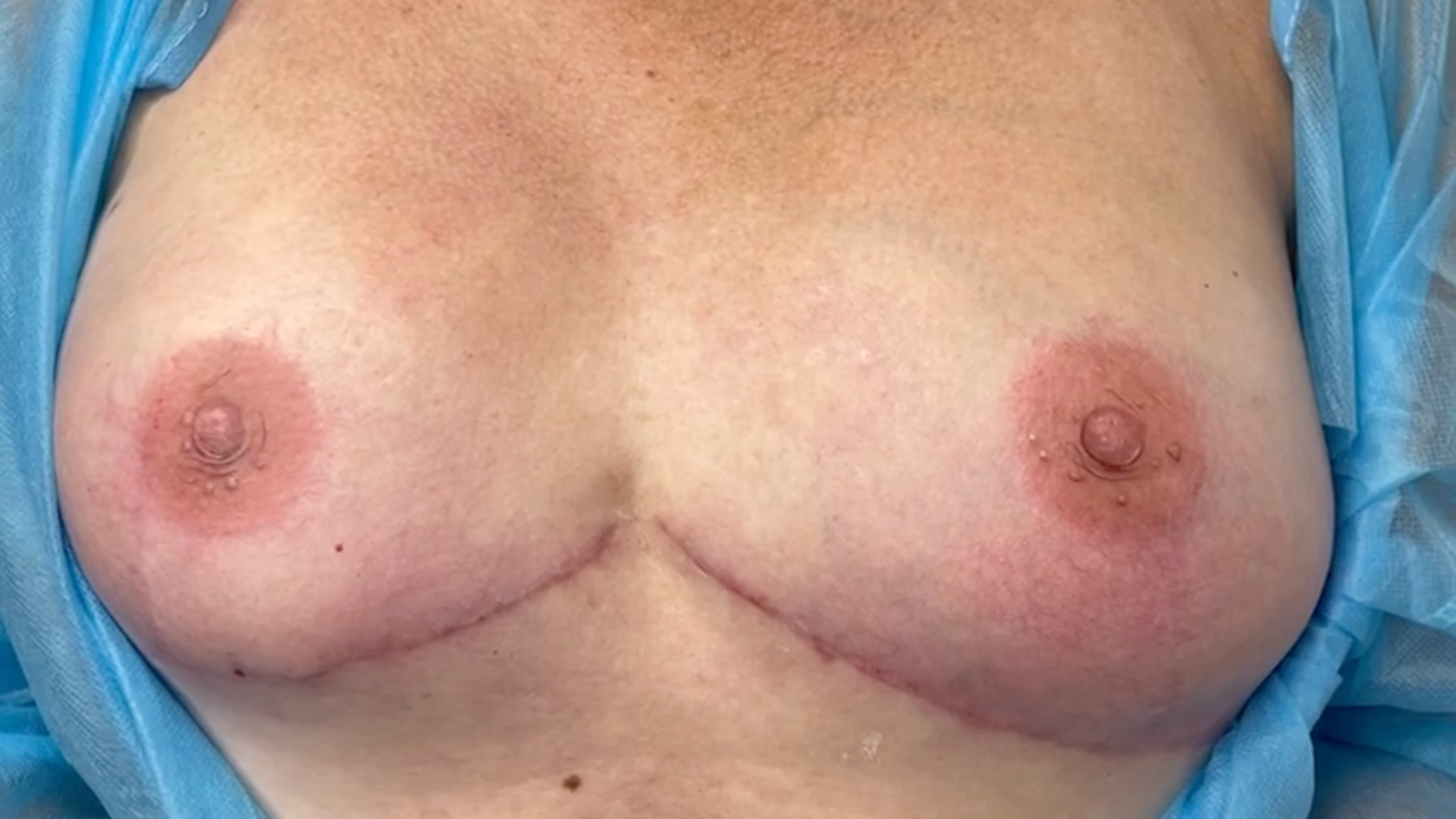 A pair of tattooed areola on the chest of a woman who's had a mastectomy. 