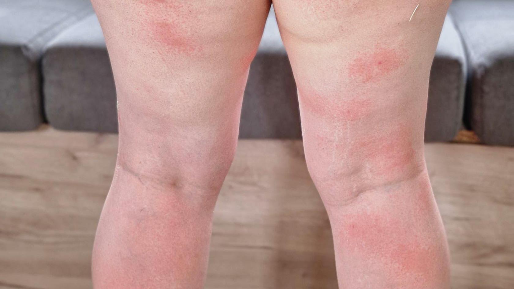The photo shows the back of two legs. There are around 12 red wasp sting marks.