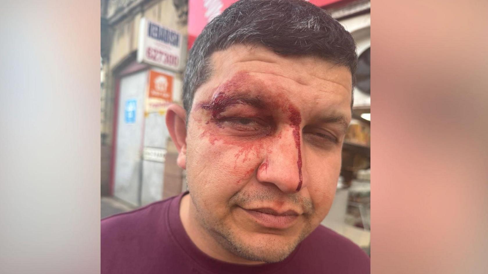 Dr Zohaib Arshad standing outside on a street with a facial injury above his left eye, with blood visible around the eye and down the side of his nose following the reported assault in Falkirk.