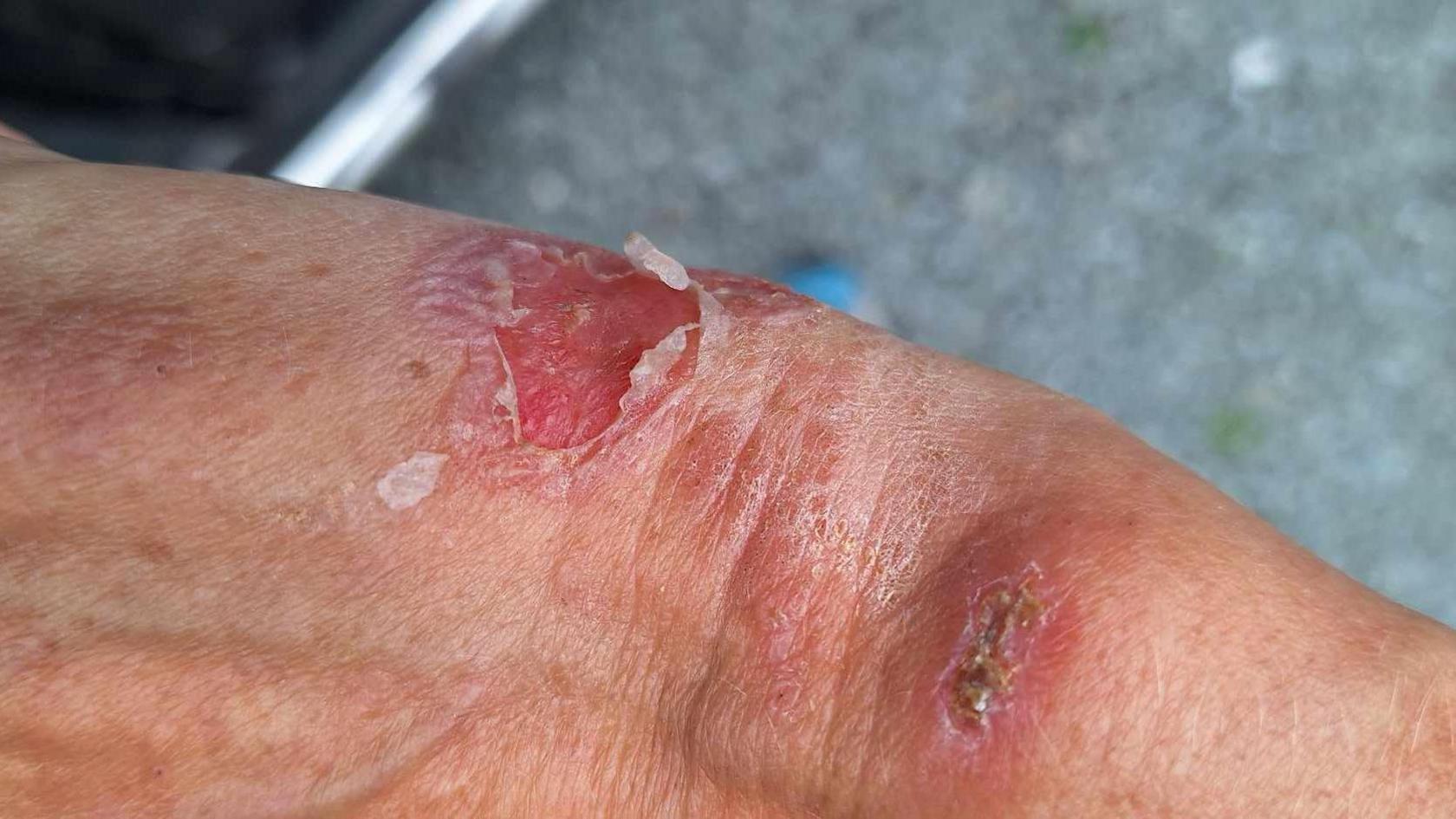 An close-up image shows inflamed blisters on Nikki Cullis's skin