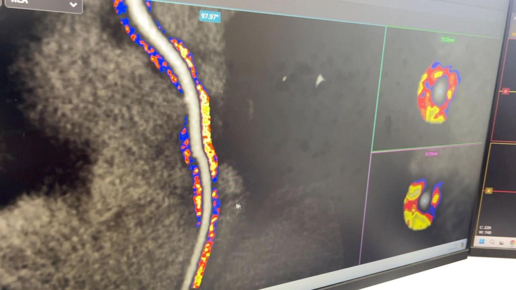 An image of fat around coronary arteries